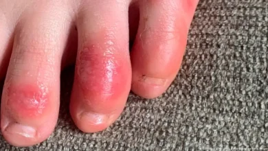 شوگر کے مریضوں کے پاؤں کے زخم بھرنے میں معاون صوتی لہریں