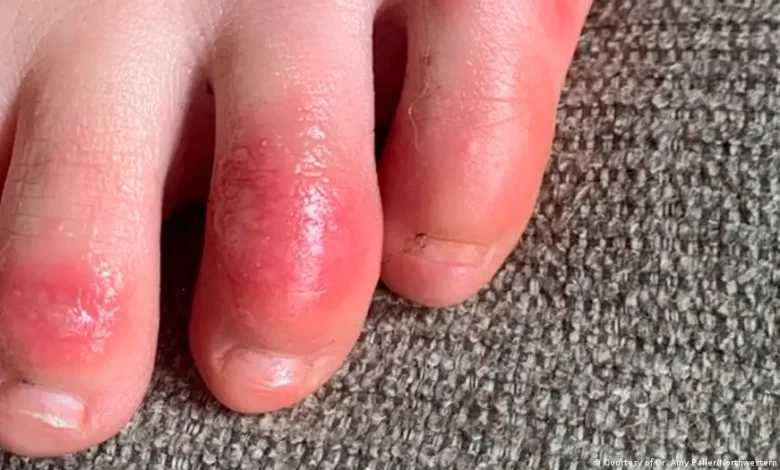 شوگر کے مریضوں کے پاؤں کے زخم بھرنے میں معاون صوتی لہریں